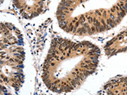 The image on the left is immunohistochemistry of paraffin-embedded Human colon cancer tissue using CSB-PA597389(CMTM3 Antibody) at dilution 1/20, on the right is treated with synthetic peptide. (Original magnification: ×200)
