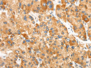 The image on the left is immunohistochemistry of paraffin-embedded Human liver cancer tissue using CSB-PA597446(SLC24A6 Antibody) at dilution 1/20, on the right is treated with synthetic peptide. (Original magnification: ×200)
