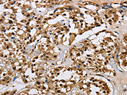 The image on the left is immunohistochemistry of paraffin-embedded Human thyroid cancer tissue using CSB-PA597489(HNRNPL Antibody) at dilution 1/40, on the right is treated with synthetic peptide. (Original magnification: ×200)