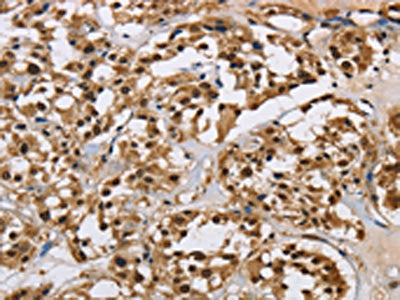 The image on the left is immunohistochemistry of paraffin-embedded Human thyroid cancer tissue using CSB-PA597489(HNRNPL Antibody) at dilution 1/40, on the right is treated with synthetic peptide. (Original magnification: ×200)