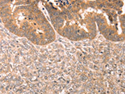 The image on the left is immunohistochemistry of paraffin-embedded Human ovarian cancer tissue using CSB-PA597518(TRPC3 Antibody) at dilution 1/80, on the right is treated with synthetic peptide. (Original magnification: ×200)