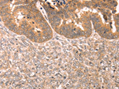 The image on the left is immunohistochemistry of paraffin-embedded Human ovarian cancer tissue using CSB-PA597518(TRPC3 Antibody) at dilution 1/80, on the right is treated with synthetic peptide. (Original magnification: ×200)