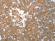 The image on the left is immunohistochemistry of paraffin-embedded Human breast cancer tissue using CSB-PA597625(SHH Antibody) at dilution 1/40, on the right is treated with synthetic peptide. (Original magnification: ×200)