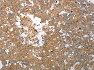 The image on the left is immunohistochemistry of paraffin-embedded Human breast cancer tissue using CSB-PA597625(SHH Antibody) at dilution 1/40, on the right is treated with synthetic peptide. (Original magnification: ×200)