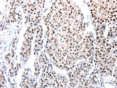 The image on the left is immunohistochemistry of paraffin-embedded Human liver cancer tissue using CSB-PA597642(AQP2 Antibody) at dilution 1/100, on the right is treated with synthetic peptide. (Original magnification: ×200)
