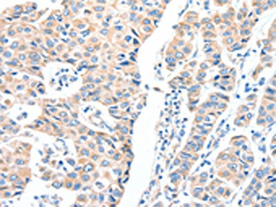 The image on the left is immunohistochemistry of paraffin-embedded Human breast cancer tissue using CSB-PA597708(ADCK1 Antibody) at dilution 1/40, on the right is treated with fusion protein. (Original magnification: ×200)