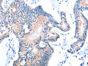 The image on the left is immunohistochemistry of paraffin-embedded Human colon cancer tissue using CSB-PA597950(ACAD11 Antibody) at dilution 1/15, on the right is treated with fusion protein. (Original magnification: ×200)