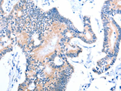 The image on the left is immunohistochemistry of paraffin-embedded Human colon cancer tissue using CSB-PA597950(ACAD11 Antibody) at dilution 1/15, on the right is treated with fusion protein. (Original magnification: ×200)