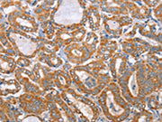 The image on the left is immunohistochemistry of paraffin-embedded Human thyroid cancer tissue using CSB-PA598045(MTMR7 Antibody) at dilution 1/40, on the right is treated with fusion protein. (Original magnification: ×200)