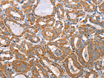 The image on the left is immunohistochemistry of paraffin-embedded Human thyroid cancer tissue using CSB-PA598045(MTMR7 Antibody) at dilution 1/40, on the right is treated with fusion protein. (Original magnification: ×200)