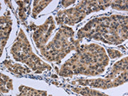 The image on the left is immunohistochemistry of paraffin-embedded Human breast cancer tissue using CSB-PA598067(IPO8 Antibody) at dilution 1/50, on the right is treated with synthetic peptide. (Original magnification: ×200)