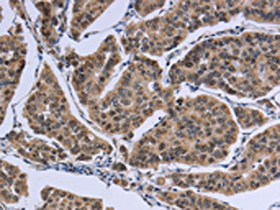 The image on the left is immunohistochemistry of paraffin-embedded Human breast cancer tissue using CSB-PA598067(IPO8 Antibody) at dilution 1/50, on the right is treated with synthetic peptide. (Original magnification: ×200)
