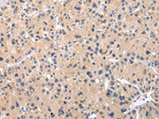 The image on the left is immunohistochemistry of paraffin-embedded Human liver cancer tissue using CSB-PA598098(CHRM5 Antibody) at dilution 1/25, on the right is treated with synthetic peptide. (Original magnification: ×200)