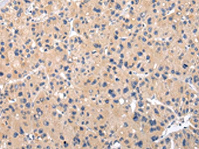The image on the left is immunohistochemistry of paraffin-embedded Human liver cancer tissue using CSB-PA598098(CHRM5 Antibody) at dilution 1/25, on the right is treated with synthetic peptide. (Original magnification: ×200)