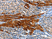 The image on the left is immunohistochemistry of paraffin-embedded Human liver cancer tissue using CSB-PA598136(AOX1 Antibody) at dilution 1/65, on the right is treated with fusion protein. (Original magnification: ×200)