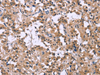The image on the left is immunohistochemistry of paraffin-embedded Human thyroid cancer tissue using CSB-PA598159(CSF2RB Antibody) at dilution 1/25, on the right is treated with synthetic peptide. (Original magnification: ×200)