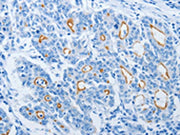 The image on the left is immunohistochemistry of paraffin-embedded Human gastic cancer tissue using CSB-PA598200(NEK10 Antibody) at dilution 1/20, on the right is treated with synthetic peptide. (Original magnification: ×200)