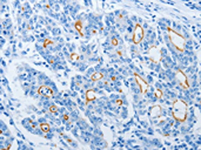 The image on the left is immunohistochemistry of paraffin-embedded Human gastic cancer tissue using CSB-PA598200(NEK10 Antibody) at dilution 1/20, on the right is treated with synthetic peptide. (Original magnification: ×200)