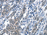 The image on the left is immunohistochemistry of paraffin-embedded Human gastic cancer tissue using CSB-PA598205(BNIP3L Antibody) at dilution 1/30, on the right is treated with synthetic peptide. (Original magnification: ×200)