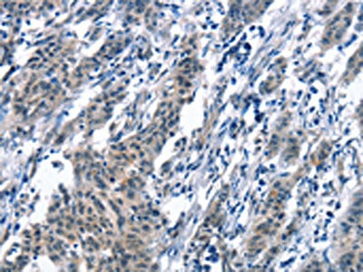The image on the left is immunohistochemistry of paraffin-embedded Human gastic cancer tissue using CSB-PA598205(BNIP3L Antibody) at dilution 1/30, on the right is treated with synthetic peptide. (Original magnification: ×200)