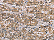 The image on the left is immunohistochemistry of paraffin-embedded Human liver cancer tissue using CSB-PA598332(CLEC16A Antibody) at dilution 1/45, on the right is treated with synthetic peptide. (Original magnification: ×200)