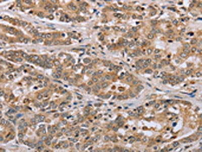 The image on the left is immunohistochemistry of paraffin-embedded Human liver cancer tissue using CSB-PA598332(CLEC16A Antibody) at dilution 1/45, on the right is treated with synthetic peptide. (Original magnification: ×200)