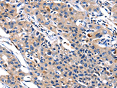 The image on the left is immunohistochemistry of paraffin-embedded Human lung cancer tissue using CSB-PA598539(MMP16 Antibody) at dilution 1/40, on the right is treated with fusion protein. (Original magnification: ×200)