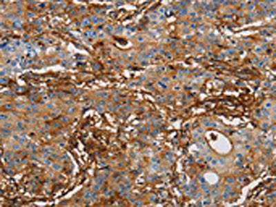 The image on the left is immunohistochemistry of paraffin-embedded Human gastic cancer tissue using CSB-PA598794(ICAM1 Antibody) at dilution 1/50, on the right is treated with fusion protein. (Original magnification: ×200)
