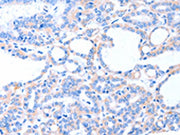 The image on the left is immunohistochemistry of paraffin-embedded Human thyroid cancer tissue using CSB-PA598870(ACAD8 Antibody) at dilution 1/20, on the right is treated with fusion protein. (Original magnification: ×200)