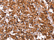 The image on the left is immunohistochemistry of paraffin-embedded Human thyroid cancer tissue using CSB-PA599022(ERAS Antibody) at dilution 1/40, on the right is treated with synthetic peptide. (Original magnification: ×200)