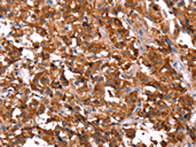 The image on the left is immunohistochemistry of paraffin-embedded Human thyroid cancer tissue using CSB-PA599022(ERAS Antibody) at dilution 1/40, on the right is treated with synthetic peptide. (Original magnification: ×200)