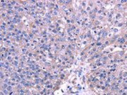 The image on the left is immunohistochemistry of paraffin-embedded Human breast cancer tissue using CSB-PA599098(TRIM49 Antibody) at dilution 1/40, on the right is treated with fusion protein. (Original magnification: ×200)