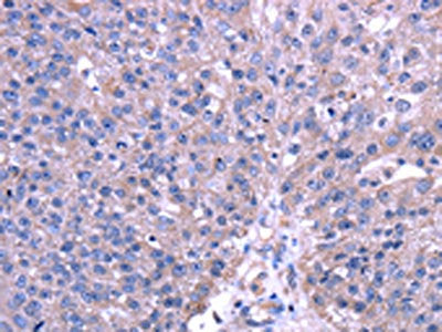 The image on the left is immunohistochemistry of paraffin-embedded Human breast cancer tissue using CSB-PA599098(TRIM49 Antibody) at dilution 1/40, on the right is treated with fusion protein. (Original magnification: ×200)