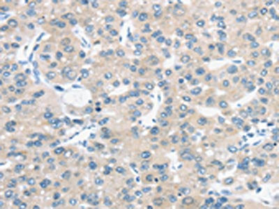 The image on the left is immunohistochemistry of paraffin-embedded Human liver cancer tissue using CSB-PA599133(TM9SF1 Antibody) at dilution 1/30, on the right is treated with synthetic peptide. (Original magnification: ×200)