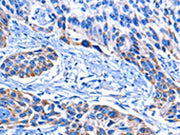 The image on the left is immunohistochemistry of paraffin-embedded Human esophagus cancer tissue using CSB-PA599265(CNGA2 Antibody) at dilution 1/25, on the right is treated with fusion protein. (Original magnification: ×200)