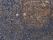 The image on the left is immunohistochemistry of paraffin-embedded Human tonsil tissue using CSB-PA599384(DSP Antibody) at dilution 1/40, on the right is treated with synthetic peptide. (Original magnification: ×200)