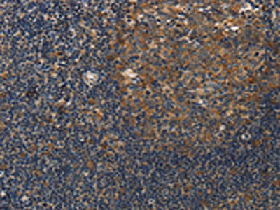 The image on the left is immunohistochemistry of paraffin-embedded Human tonsil tissue using CSB-PA599384(DSP Antibody) at dilution 1/40, on the right is treated with synthetic peptide. (Original magnification: ×200)