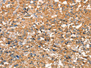 The image on the left is immunohistochemistry of paraffin-embedded Human thyroid cancer tissue using CSB-PA599713(ARFGEF2 Antibody) at dilution 1/50, on the right is treated with synthetic peptide. (Original magnification: ×200)