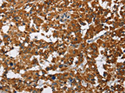 The image on the left is immunohistochemistry of paraffin-embedded Human thyroid cancer tissue using CSB-PA599838(CAT Antibody) at dilution 1/40, on the right is treated with fusion protein. (Original magnification: ×200)