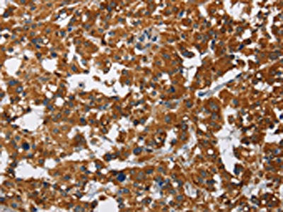 The image on the left is immunohistochemistry of paraffin-embedded Human thyroid cancer tissue using CSB-PA599838(CAT Antibody) at dilution 1/40, on the right is treated with fusion protein. (Original magnification: ×200)