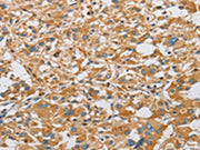 The image on the left is immunohistochemistry of paraffin-embedded Human thyroid cancer tissue using CSB-PA600132(ARHGEF7 Antibody) at dilution 1/40, on the right is treated with fusion protein. (Original magnification: ×200)