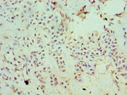 Immunohistochemistry of paraffin-embedded human breast cancer using CSB-PA600854ESR2HU at dilution of 1:100