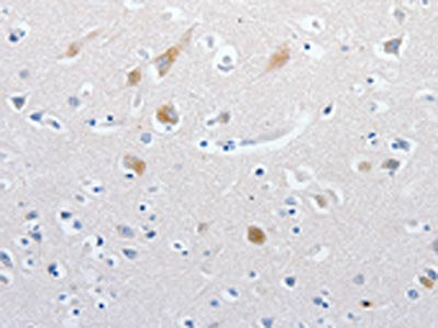 The image on the left is immunohistochemistry of paraffin-embedded Human brain tissue using CSB-PA602770(MATN1 Antibody) at dilution 1/60, on the right is treated with synthetic peptide. (Original magnification: ×200)