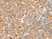 The image on the left is immunohistochemistry of paraffin-embedded Human liver cancer tissue using CSB-PA605333(ZFP36L2 Antibody) at dilution 1/45, on the right is treated with synthetic peptide. (Original magnification: ×200)