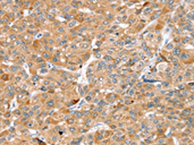The image on the left is immunohistochemistry of paraffin-embedded Human liver cancer tissue using CSB-PA605333(ZFP36L2 Antibody) at dilution 1/45, on the right is treated with synthetic peptide. (Original magnification: ×200)