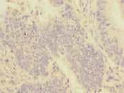 Immunohistochemistry of paraffin-embedded human colon cancer using CSB-PA606021ESR1HU at dilution of 1:100