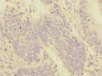 Immunohistochemistry of paraffin-embedded human colon cancer using CSB-PA606021ESR1HU at dilution of 1:100
