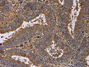 The image on the left is immunohistochemistry of paraffin-embedded Human colon cancer tissue using CSB-PA607012(FADS1 Antibody) at dilution 1/60, on the right is treated with fusion protein. (Original magnification: ×200)