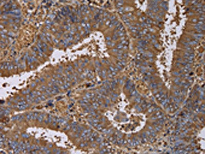 The image on the left is immunohistochemistry of paraffin-embedded Human colon cancer tissue using CSB-PA607012(FADS1 Antibody) at dilution 1/60, on the right is treated with fusion protein. (Original magnification: ×200)