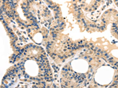 The image on the left is immunohistochemistry of paraffin-embedded Human thyroid cancer tissue using CSB-PA608547(TPSB2 Antibody) at dilution 1/20, on the right is treated with fusion protein. (Original magnification: ×200)